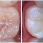 برای جلوگیری از پوسیدگی دندان کودکان چه کنیم؟