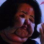 زشت ترین زن جهان در کره بر اثر تزریق افراطی سیلیکون